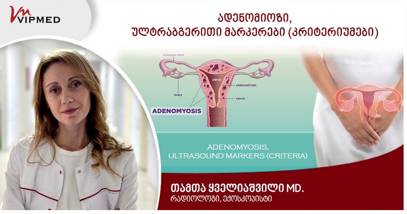 Adenomyosis