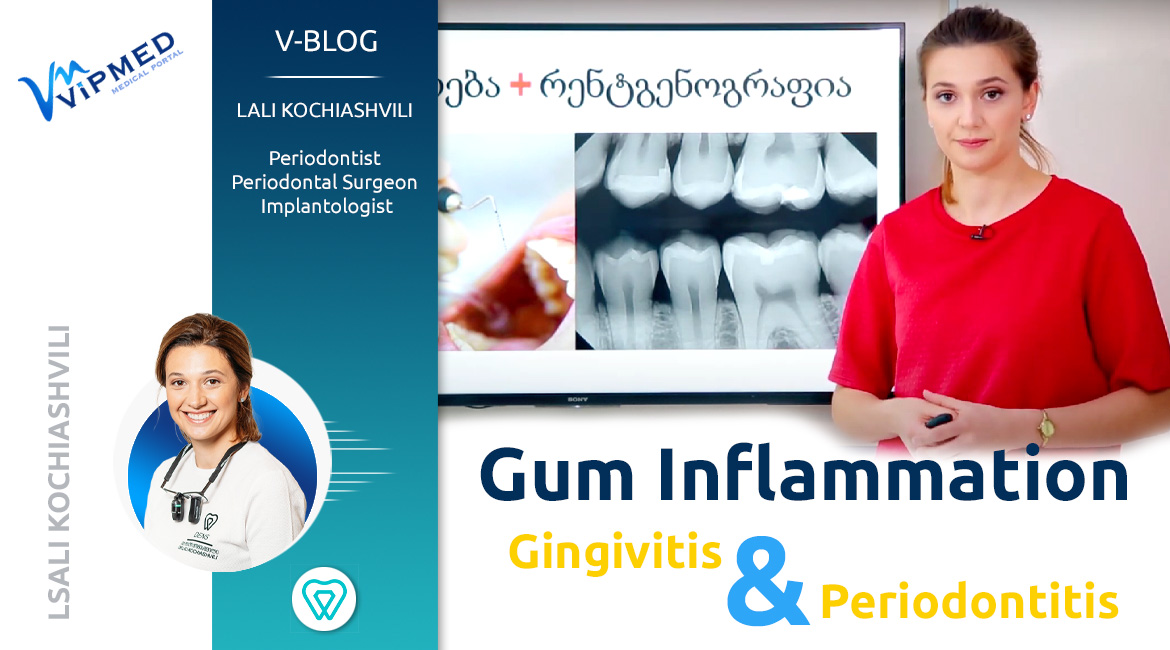 Gingivitis and Periodontitis